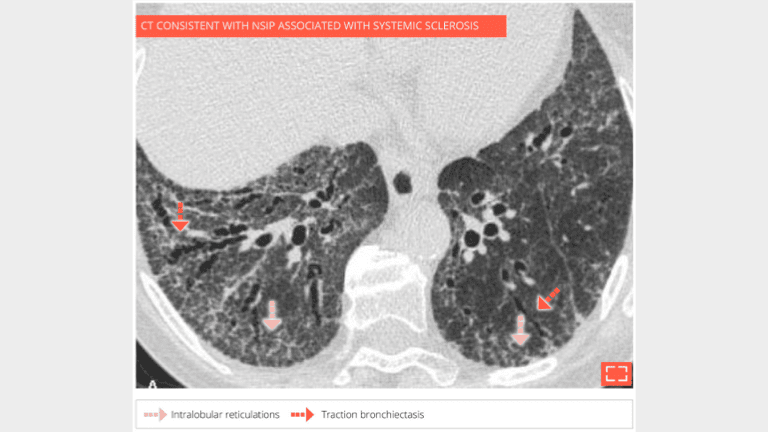 1. Intralobular reticulations associated with ground-glass opacity