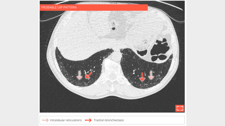 3. Intralobular reticulations