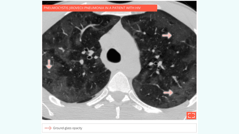 Patchy ground-glass opacity
