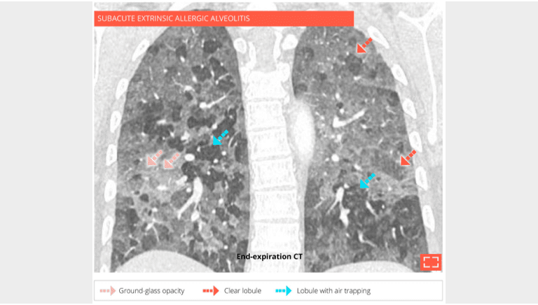 Head cheese sign of pulmonary mosaic attenuation
