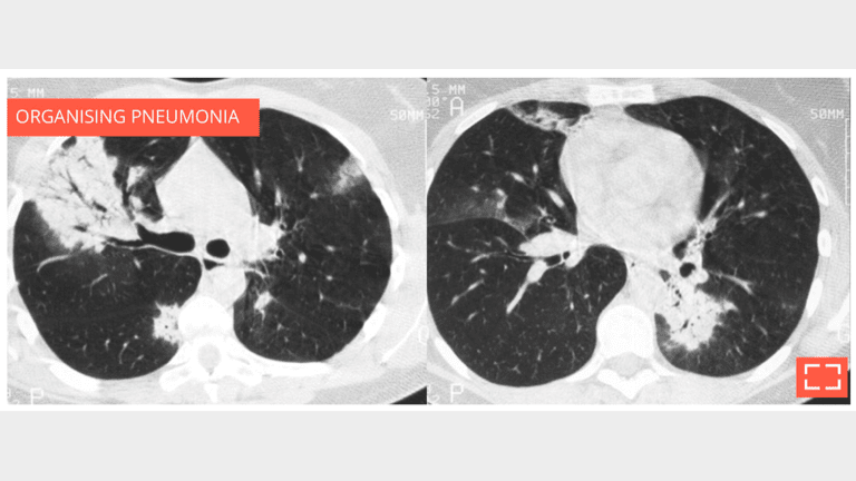 Alveolar consolidation