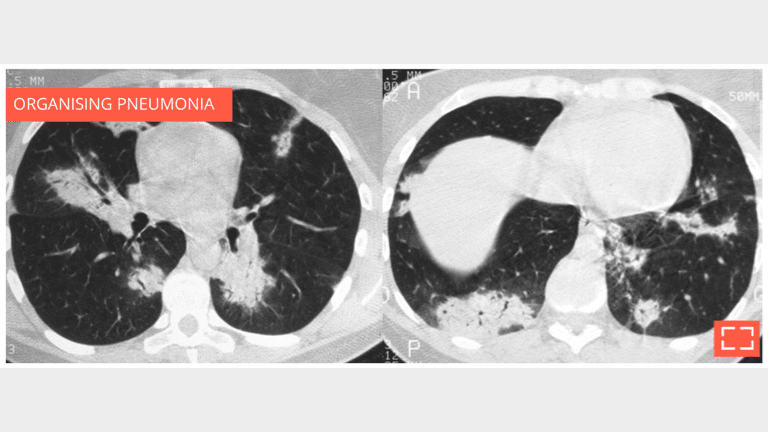 3. Alveolar consolidation