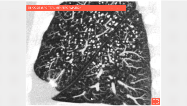 2. Traction bronchiectasis