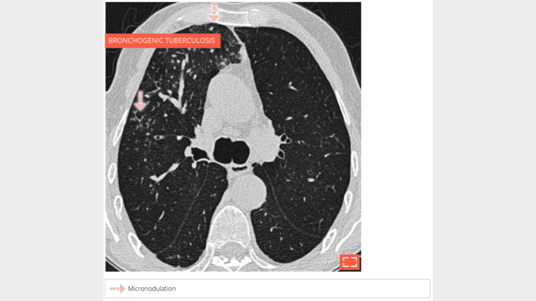 3. Traction bronchiectasis